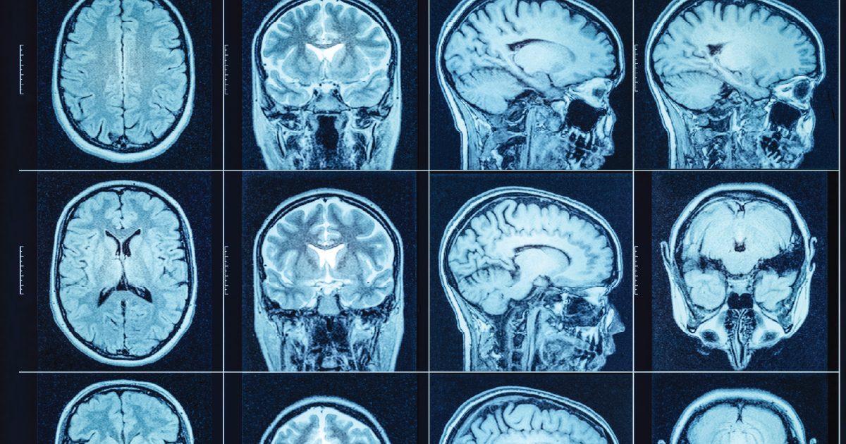 Image of brain scans.