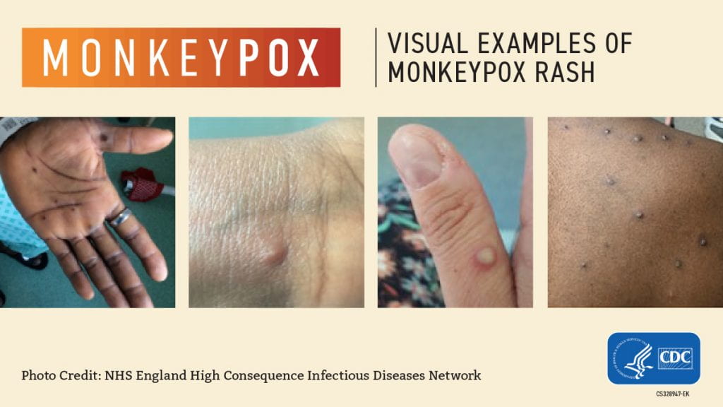 CDC infographic titled Visual Examples of Monkeypox Rash showing four photos of mpox skin lesions on a palm, wrist, finger and back