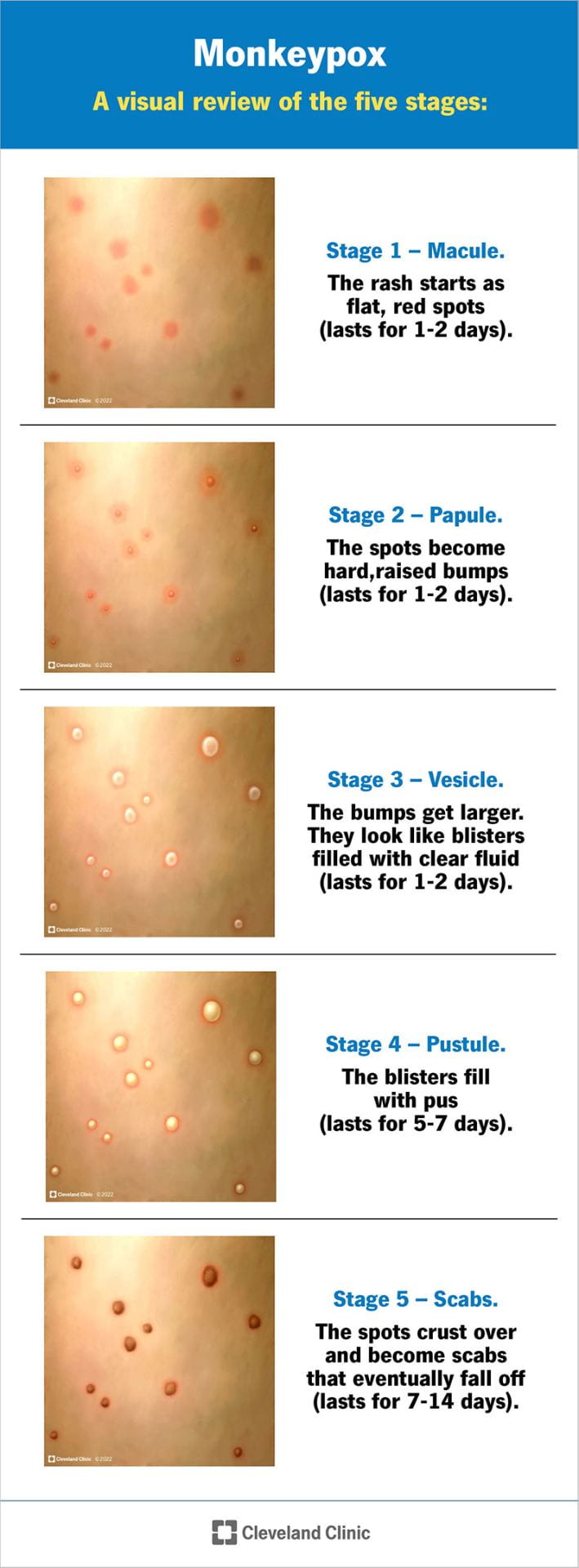 Cleveland Clinic infographic illustrating the five stages of an mpox rash with clinical illustrations: stage 1, flat red spots (macules, 1–2 days); stage 2, raised bumps (papules, 1–2 days); stage 3, fluid-filled blisters (vesicles, 1–2 days); stage 4, pus-filled blisters (pustules, 5–7 days); and stage 5, scabs that crust over and eventually fall off (7–14 days).