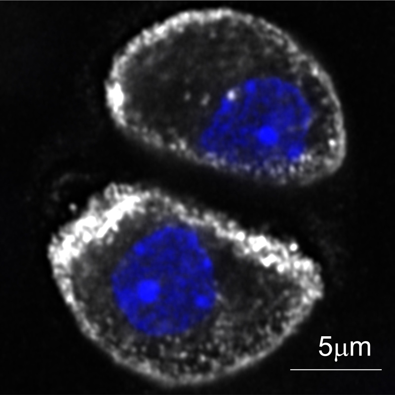 The blue area is the cell nucleus, the white area is F-actin, the structural scaffolding of the cells. Researchers discovered adseverin regulates the amount of F-actin in the cells. In osteoarthritis loss of F-actin can eventually lead to cell death. 